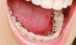lingual braces