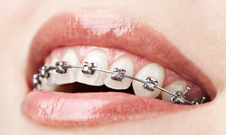 Rubber Bands for Braces  Garcia Orthodontics Miami FL